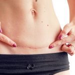 Imagen ilustrativa de una cicatriz abdominal madura