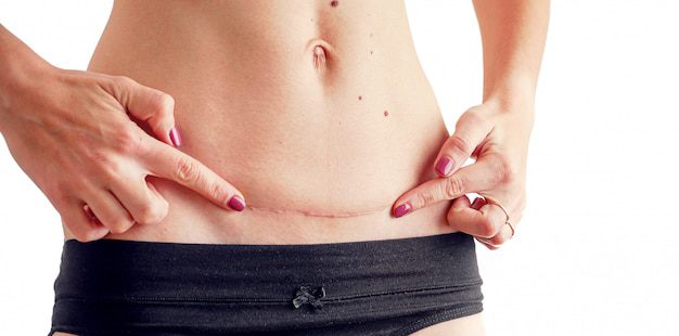 Imagen ilustrativa de una cicatriz abdominal madura