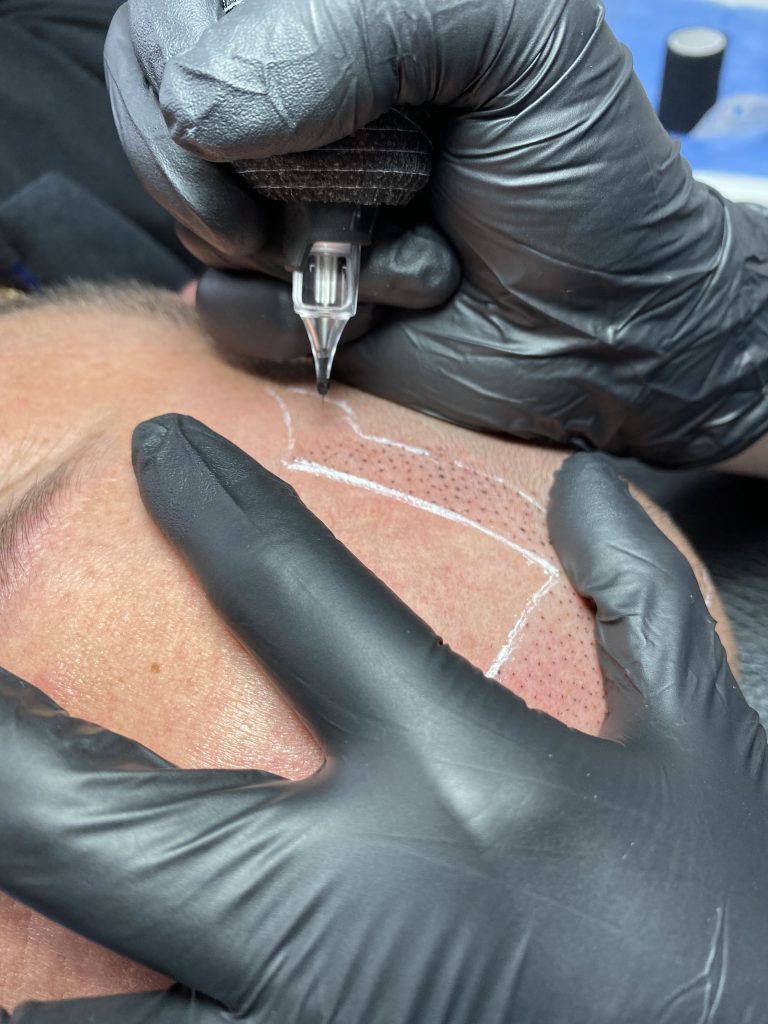 Performing,Hair,Micropigmentation,Procedure,First,Session