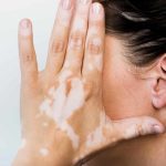 Imagen ilustrativa de vitíligo en la mano y el rostro de una mujer