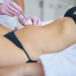 Dermatologist using a sterile gauze pad during the medical procedure