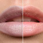 dark-lip-treatment-before-and-after